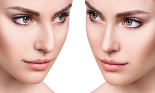 جراحی بینی با دو میلیون تومان