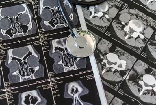 هزینه عمل آندوسکوپی سینوس