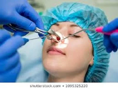 جراحی آندوسکوپی سینوس