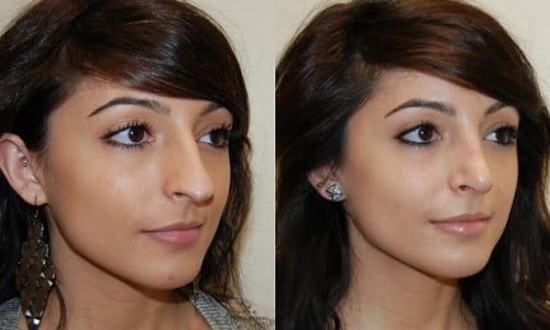 جراحی رینوپلاستی